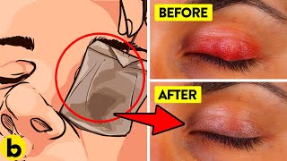 14 Easy Home Remedies For Styes You Need To Know