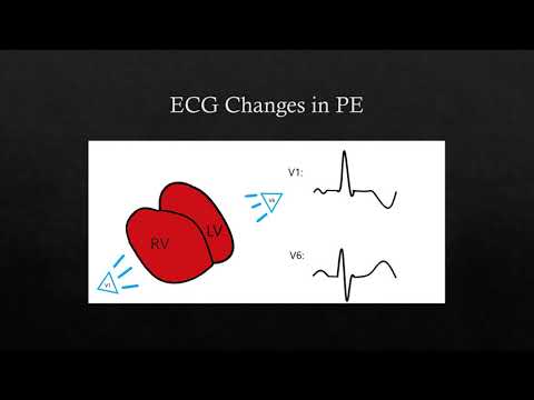 PE in the ECG Video