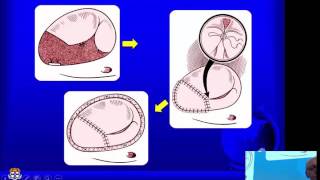 Surgical options for tricuspid valve pathology – Prof Richard Chard