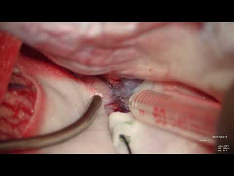 Sylvian Fissure Dissection Technique