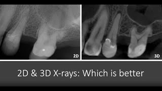 2D and 3D X-rays: Which is Better?