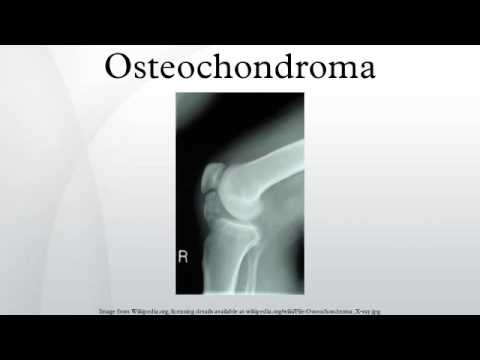 骨軟骨腫 (Osteochondroma)