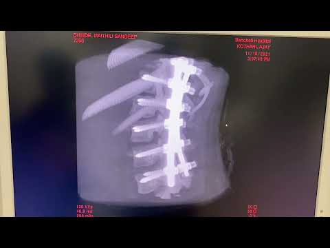 Robotic spine surgery :Scoliosis surgery complete cure