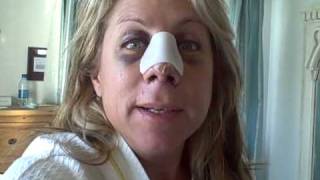 Dr. Nassif Did My New Nose: Day 3