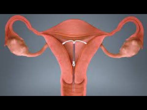 Intrauterine Device IUD