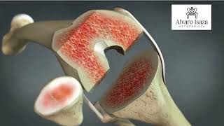 Reemplazo total de Rodilla - Alvaro  Isaza Cardona