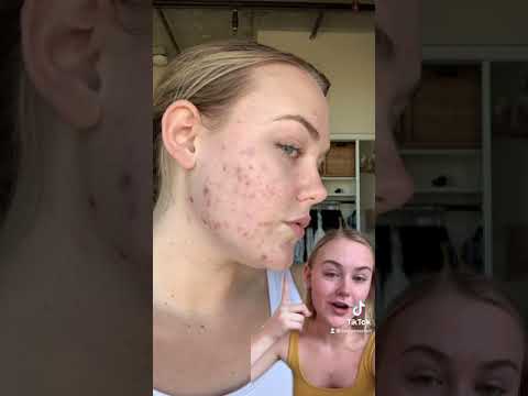 3 Month Accutane Update #shorts