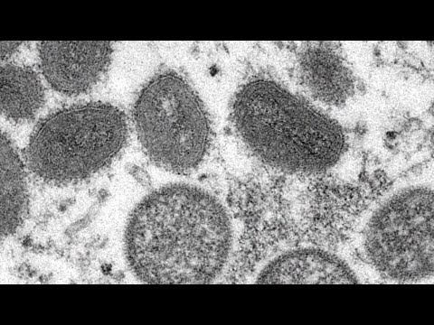 U. S. Monkeypox Cases Latest
