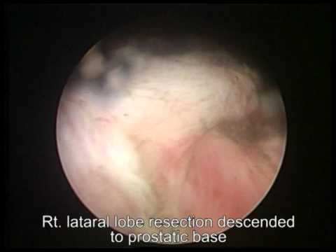 Zone calcificazione della prostata periuretrale Calcificazioni nella ghiandola prostatica
