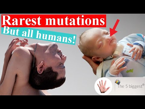 5 Real People You did NOT know Existed !! Rarest Medical Conditions! ~ Body Bizarre!
