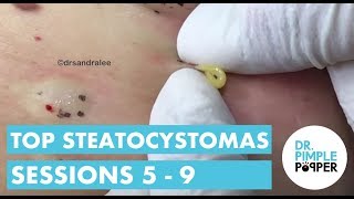 2016 Top Steatocystomas Sessions 5-9 Revisted