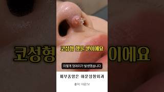 비염수술로 코모양 예뻐질까? #비중격만곡증수술