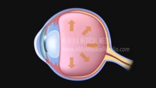 Acute Angle-Closure Glaucoma Awareness (Original Mix)