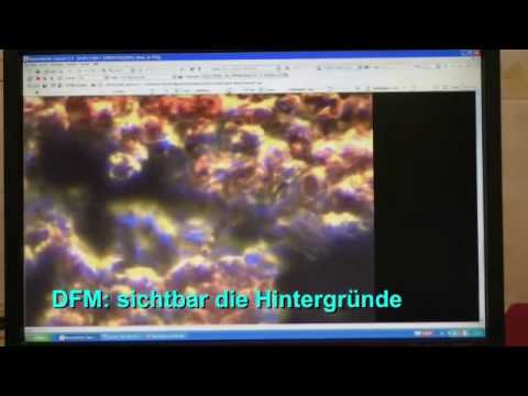Die konservative Behandlung von Bandscheibenbruch Ständige Schmerzen mit Radikulitis