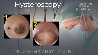 Mild Asherman with PRP administration