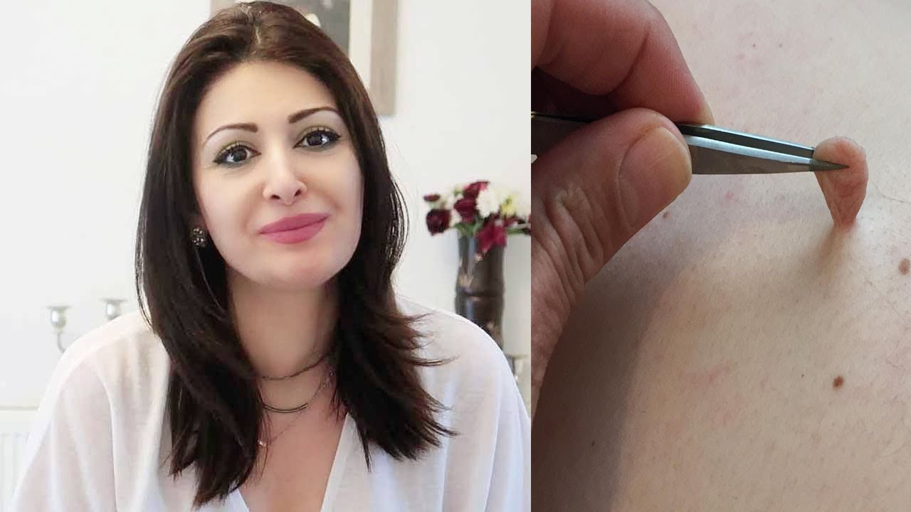 زگیل پوستی در همه نقاط بدن با این ۴ راه خانگی فوق العاده آسون با صددرصد گارانتی چند روزه از بین میره