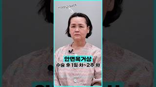 목 리프트 성형 시술