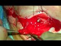 Giant fornix syndrome repair