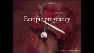 TPEA Lifter - Gynecologic Surgery