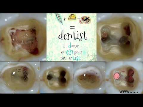 Gold Endodontics - Protaper Gold. (Dental TTT - Webinar No 31).