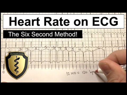 ECG Heart Rate Calculation - The Six Second Method!
