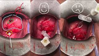 Cervix distortion by previous DIE surgery