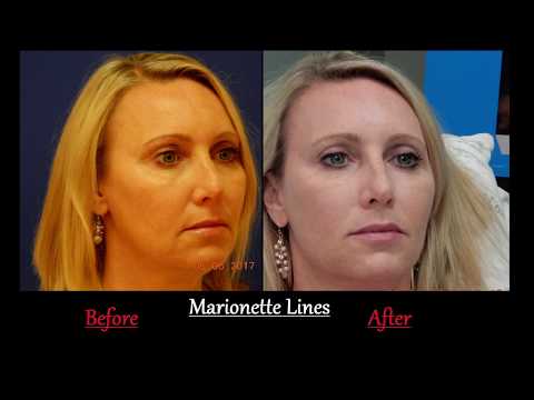 download lagu mp3 mp4 Voluma For Marionette Lines, download lagu Voluma For Marionette Lines gratis, unduh video klip Voluma For Marionette Lines