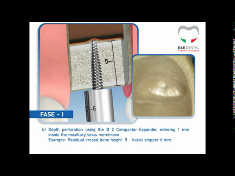 Sinus lift surgical protocol