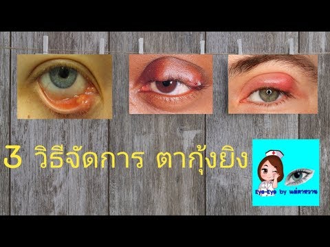โรคสะเก็ดเงินระหว่างนิ้วมือ ไม่น้ำส้มสายชูรักษาโรคสะเก็ดเงิน
