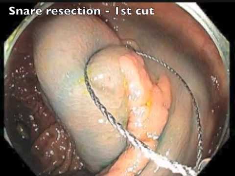 Lésion Plane de la Valvule Iléo-cæcale - Résection Muqueuse Endoscopique