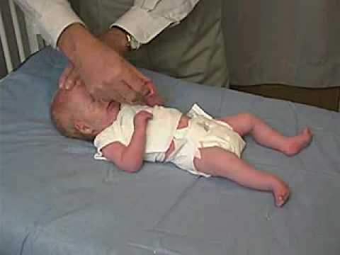 neurology exam: newborn-abnormal: Tone - Scarf Sign
