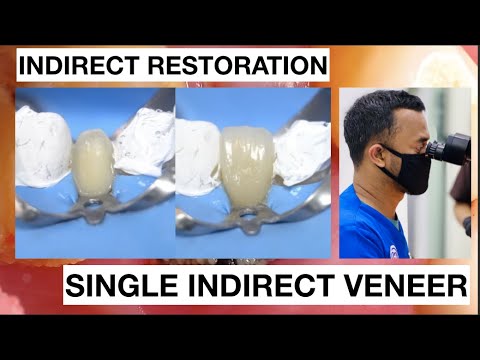 Step by Step Single Indirect Veneer Restoration
