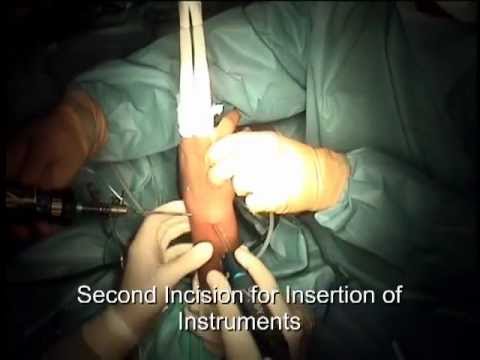 Artroskopia nadgarstka - uszkodzenie więzadła łódeczkowato-księżycowatego