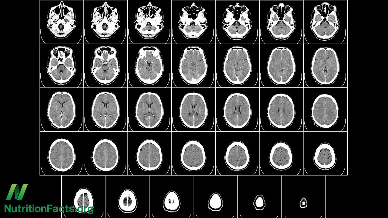 Preventing Brain Loss with B Vitamins?
