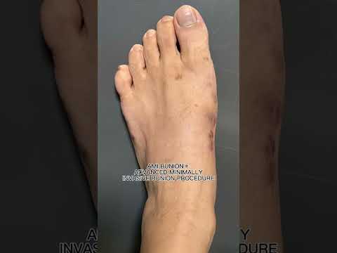 Incredible Bunion Transformations
