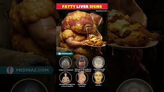 6 Common Signs of Fatty Liver Disease You Should Not Ignore