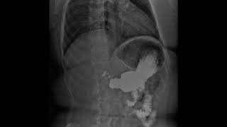 Dynamic Digital Radiology Retrospective View: Esophagogastroduodenoscopy (SEGD) part 5