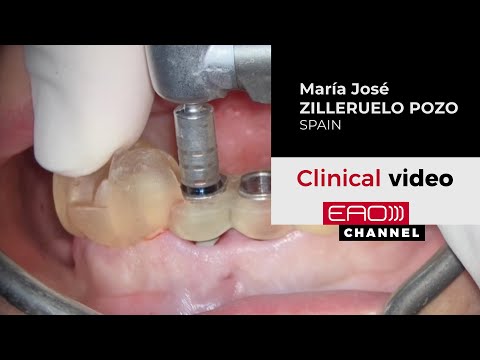 Immediate Implants In Central Incisors. A Challenge In the Aesthetic Zone. Fully digital protocol
