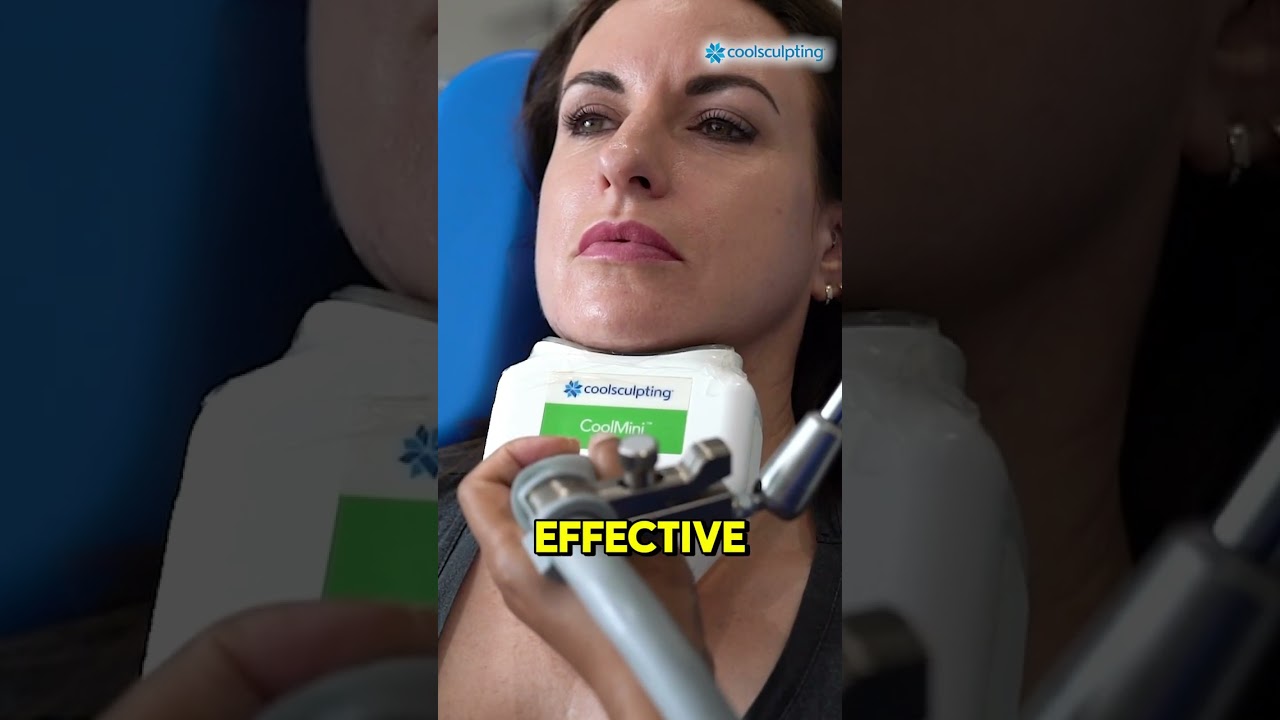 Double Chin CoolSculpting Video
