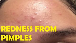 how to get rid of redness from pimples overnight