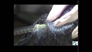 prp for hair loss حقن الرأس بالبلازما