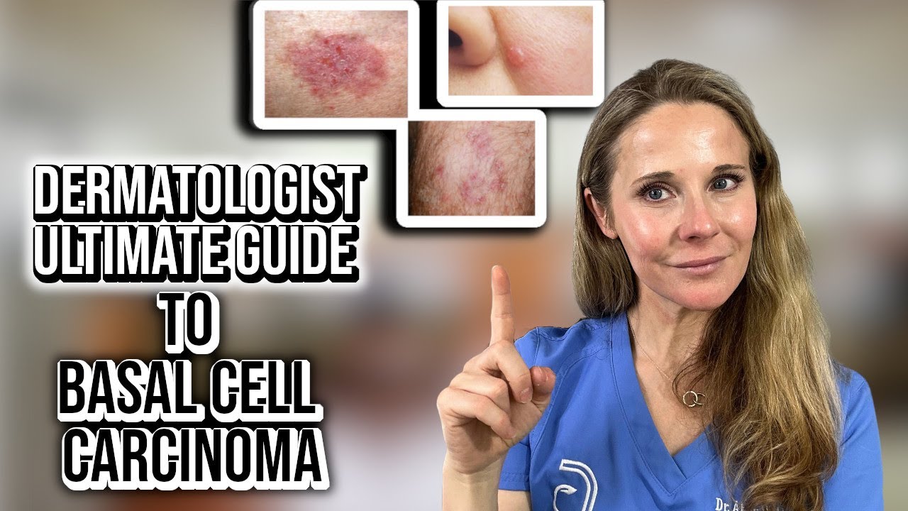 Dermatologist ultimate guide to Basal Cell Carcinoma