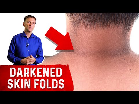 Which Vitamin Deficiency Causes Chapped Cracked Lips – Dr Berg