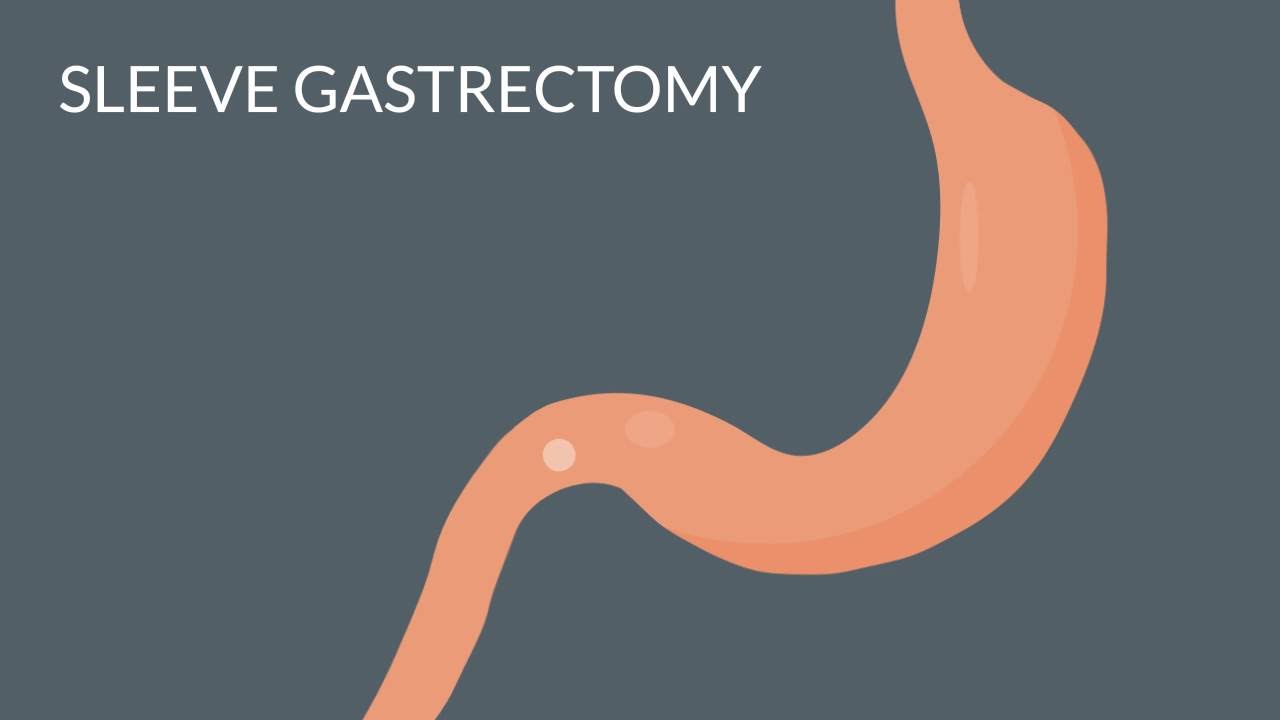 Bariatric Surgery Options