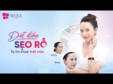 Dứt Điểm Sẹo Rỗ Sau 1 Liệu Trình Với Công Nghệ Laser Scar CO2
