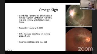 Download Lagu AIOS ARC Enhancing Concepts OCT u0026 OCT... Dr VINOD KUMAR AGARWAL Thumbnail