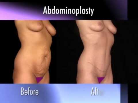 Dr. Nachbar on Abdominoplasty (Tummy Tuck)