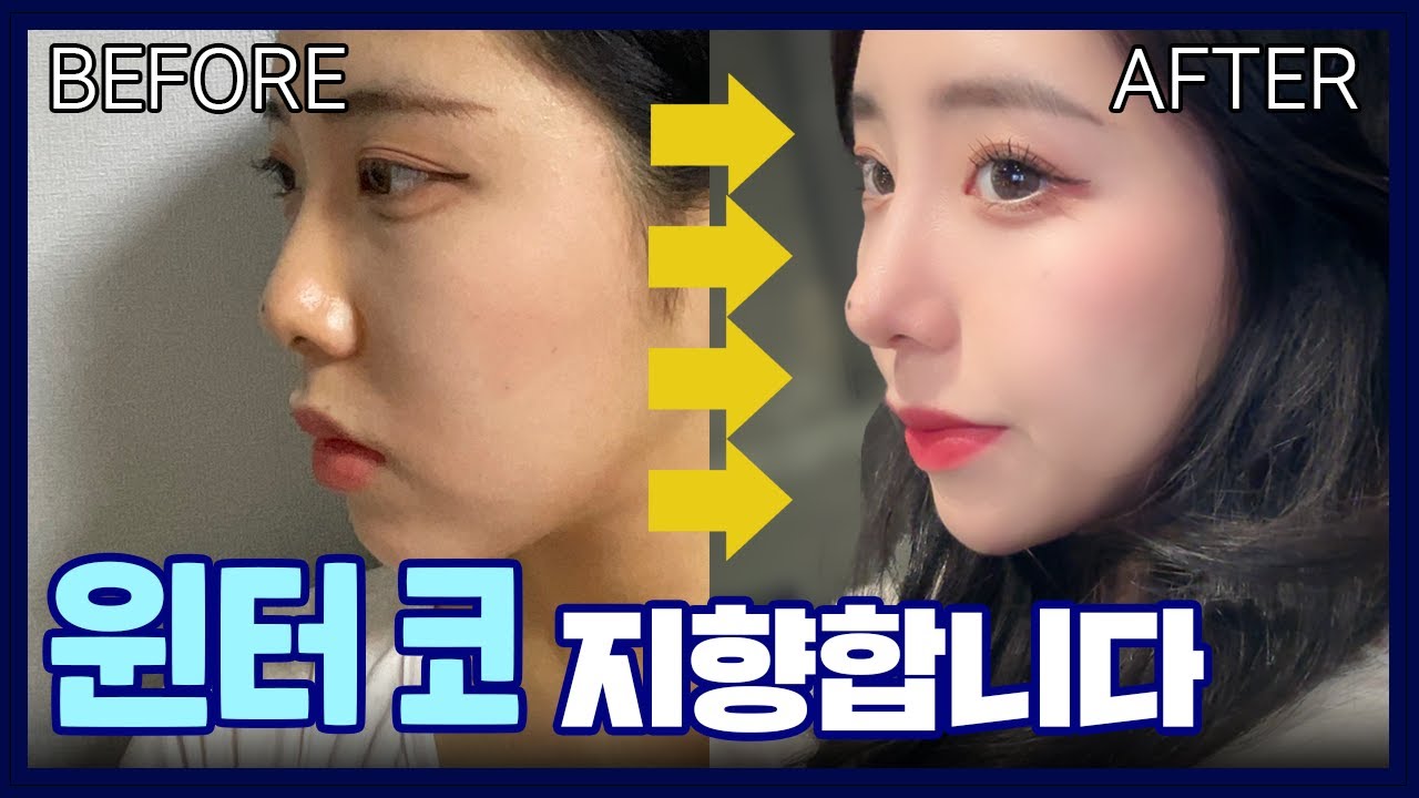 [코성형후기] 자연스럽게. 윈터 코 갖고 싶어요? #코성형후기 #성형레전드 ｜서울아이성형외과