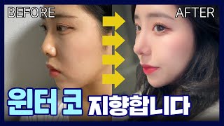 [코성형후기] 자연스럽게. 윈터 코 갖고 싶어요? #코성형후기 #성형레전드 ｜서울아이성형외과