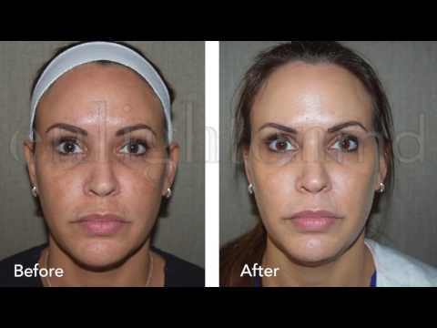 Cosmelan | Melasma Treatment | Enlighten MD